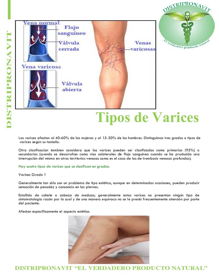 Tipos de varices